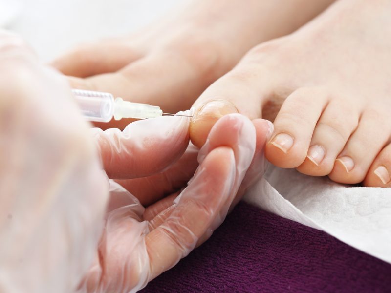 Everything You Need To Know About Ingrown Toenails And How To Treat Them