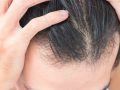Secrets To Fix Uneven Hairlines And Regain Your Natural Look