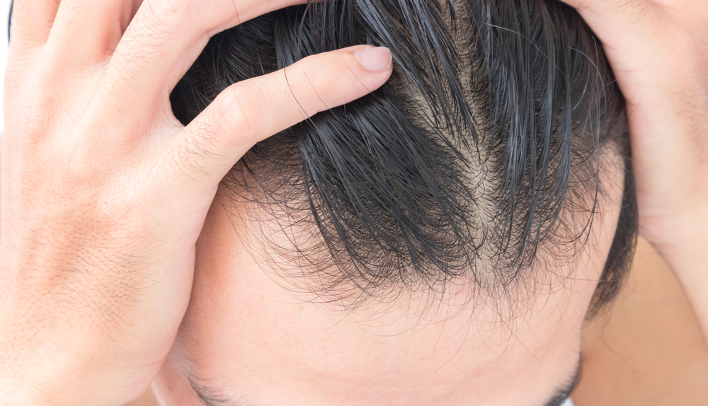 Secrets To Fix Uneven Hairlines And Regain Your Natural Look