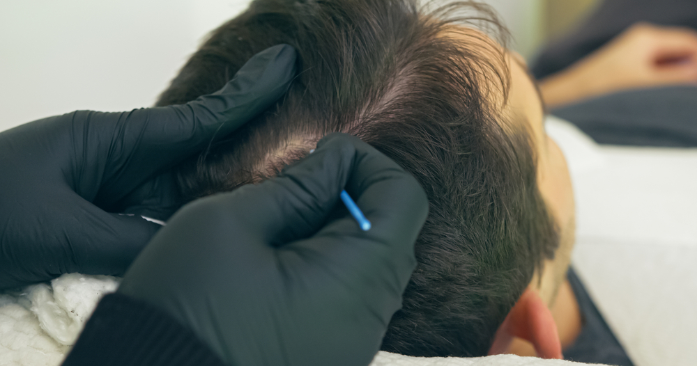 What Is Scalp Micropigmentation And How Can It Improve Your Hairline?