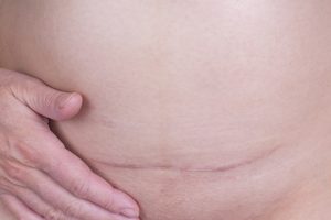 Unveiling The Secrets Of Effective Scar Therapy