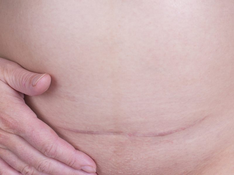 Unveiling The Secrets Of Effective Scar Therapy