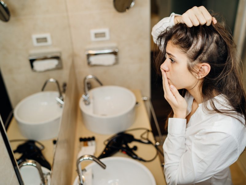 Beyond Hair Loss Navigating The Challenges Of Alopecia And Finding Hope In Treatment Approaches